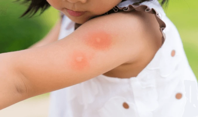 little girl with  mosquito bites in her arm