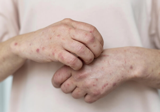 Eczema Aggravation