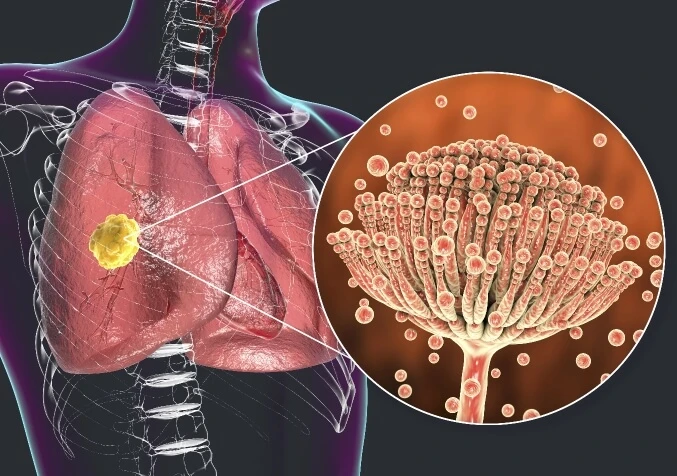 Why is Mould Bad for You?